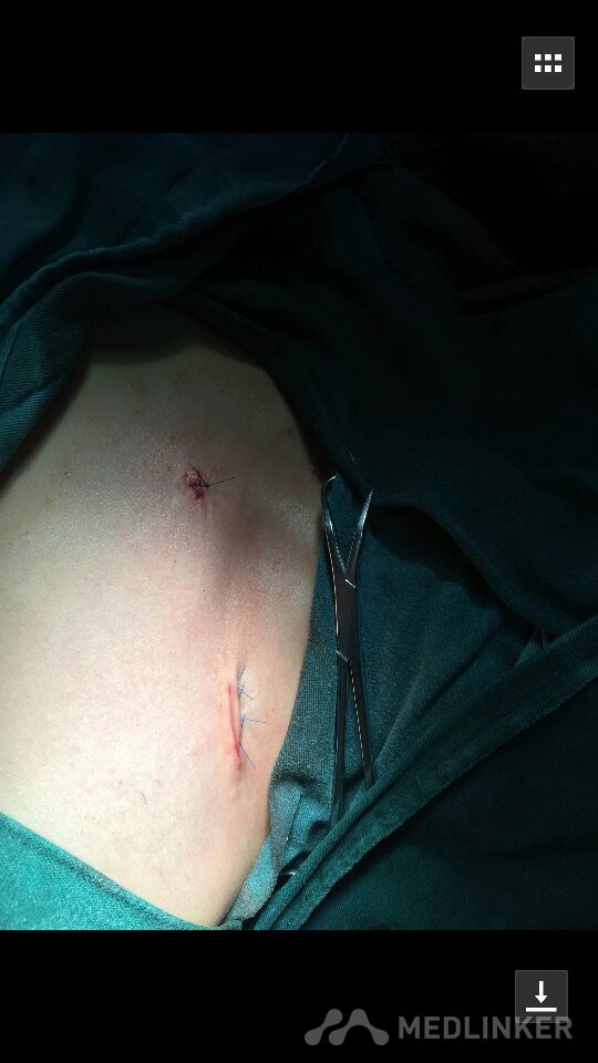 外伤至左侧锁骨骨折30分钟