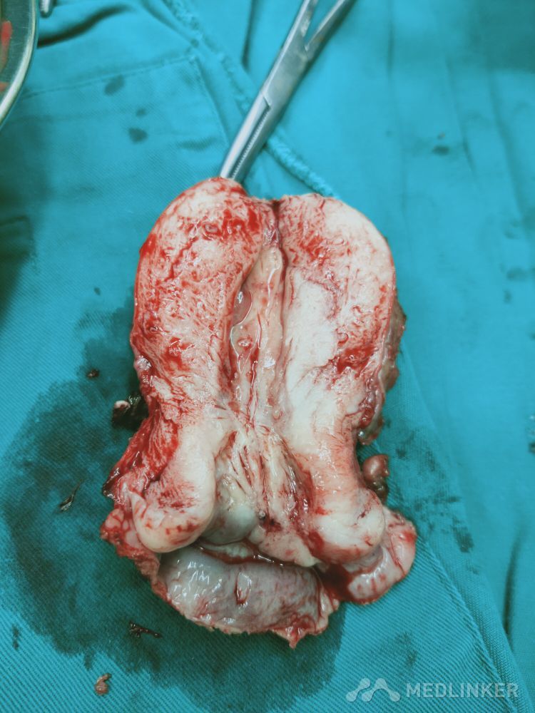 宫颈癌鳞癌闭孔窝淋巴结转移