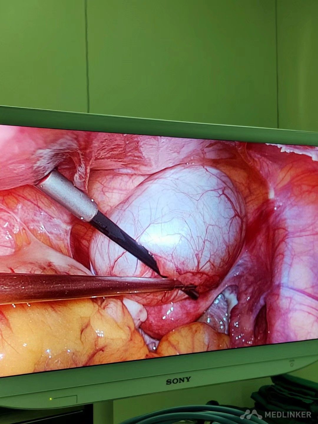 左侧卵巢冠囊肿,行腹腔镜下囊肿剥除手术-医联