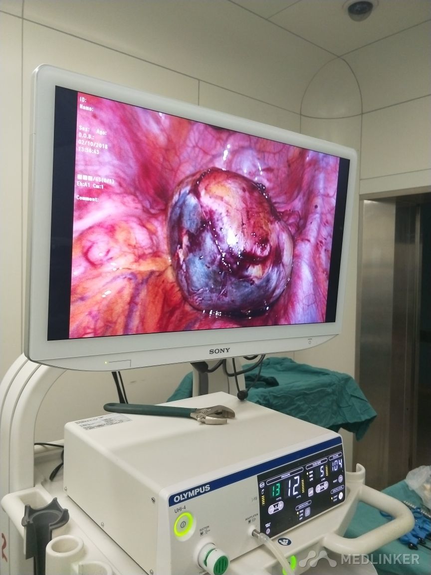 崎胎瘤 手术图片
